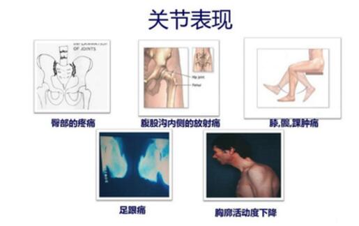关节表现 关节表现.jpg