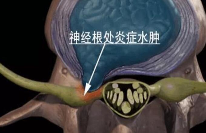 神经根处炎症水肿