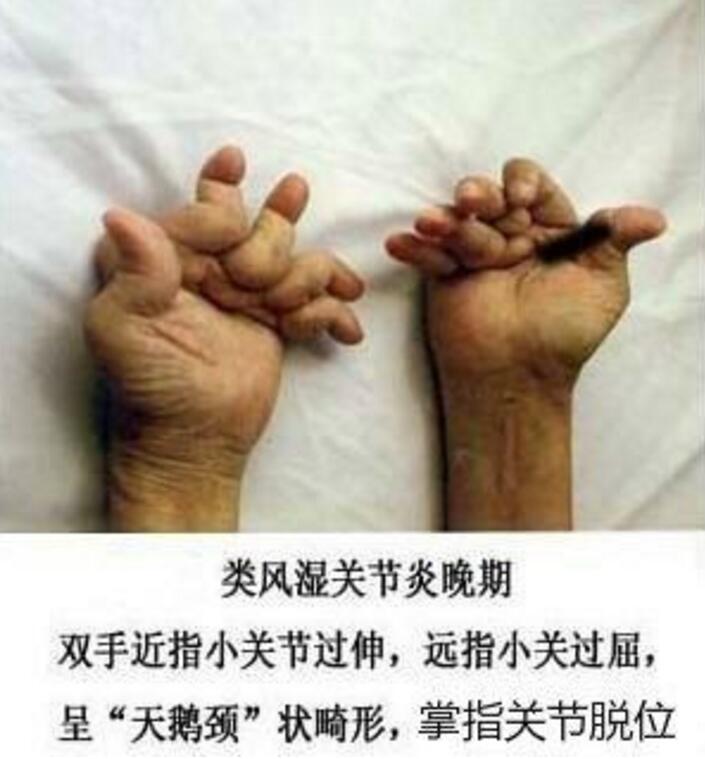 每日工作洗碗,类风湿让她手指关节疼痛不堪_郑州类风湿研究院.jpg 每日工作洗碗,类风湿让她手指关节疼痛不堪_郑州类风湿研究院