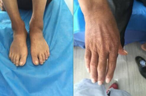 治疗前双手指关节、双足关节轻微变形 治疗前双手指关节、双足关节轻微变形.jpg