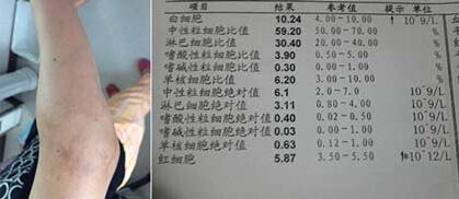郑州痛风风湿病医院患者治疗前关节症状和检查化验单 郑州痛风风湿病医院患者治疗前关节症状和检查化验单.jpg