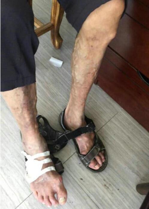 张大爷脚部痛风石溃破 张大爷脚部痛风石溃破.jpg