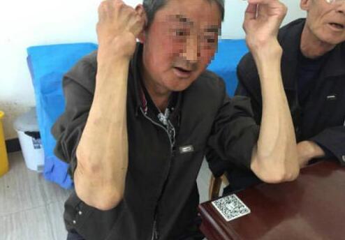 张大爷手肘处分布多个大小不一痛风石 张大爷手肘处分布多个大小不一痛风石.jpg