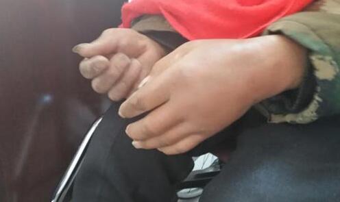 吴先生左手肿胀按压有明显痛感 吴先生左手肿胀按压有明显痛感.jpg