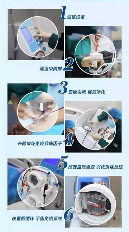 免疫吸附技术步骤解析图 风湿免疫吸附技术治疗效果好