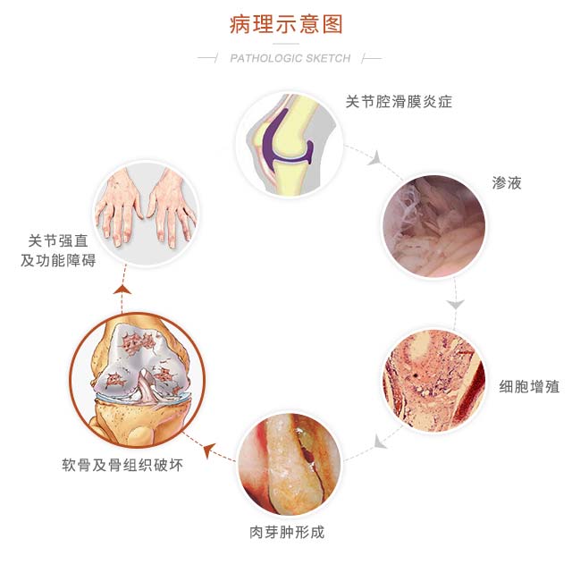 关节PRP技术病理示意图 关节PRP技术落户郑州痛风风湿病医院
