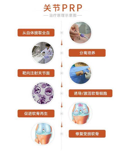 关节PRP技术 关节PRP技术落户郑州痛风风湿病医院