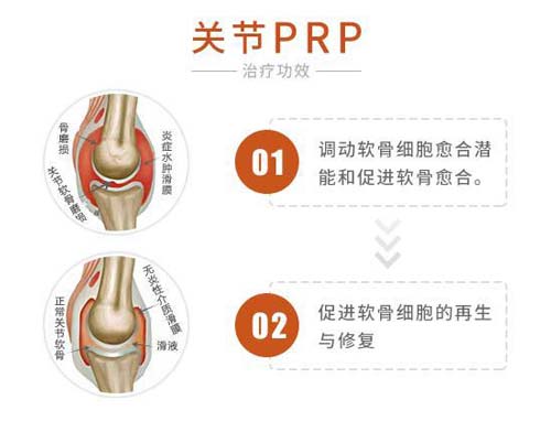 关节PRP技术治疗功效 关节PRP技术落户郑州痛风风湿病医院