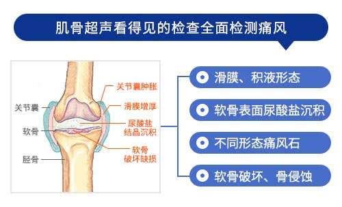 肌骨超声技术检查 什么是肌骨超声?郑州痛风风湿病医院为您讲解