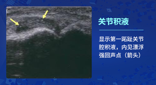 关节积液 什么是肌骨超声?郑州痛风风湿病医院为您讲解