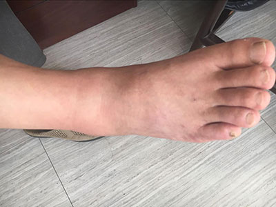 为你解决喝酒应酬引来痛风纠缠 中医微创可视针刀镜技术为你解决喝酒应酬引来痛风纠缠