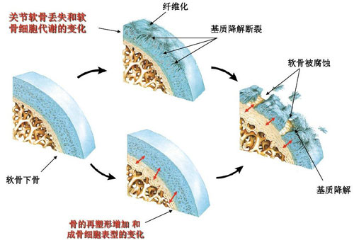 肌骨超声技术 肌骨超声技术在治疗骨关节炎上临床应用