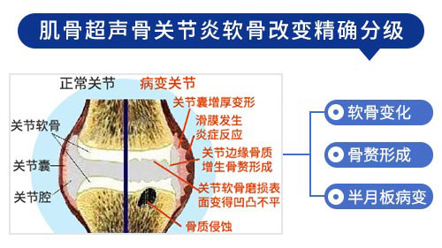 肌骨超声技术 肌骨超声技术在治疗骨关节炎上临床应用