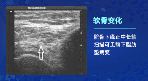 新一代MSUS肌骨超声技术 肌骨超声技术在治疗骨关节炎上临床应用