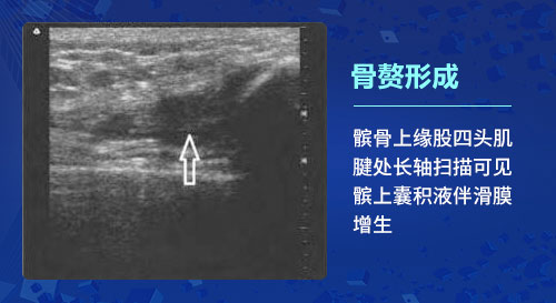 肌骨超声技术 肌骨超声技术在治疗骨关节炎上临床应用