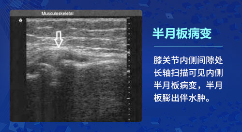肌骨超声技术 肌骨超声技术在治疗骨关节炎上临床应用