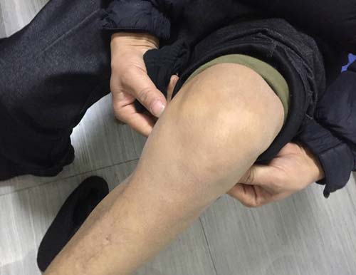 治疗前,徐先生左膝关节肿胀难以伸直 科学疗法根源出发对症治疗痛风