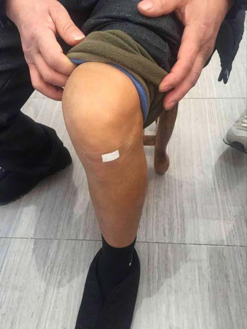 经治疗后,患者脚踝、膝关节恢复良好 科学疗法根源出发对症治疗痛风