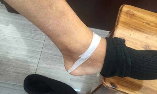 经治疗后,患者脚踝、膝关节恢复良好 科学疗法根源出发对症治疗痛风