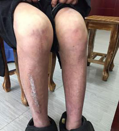 邓先生的腿部症状图,可见关节肿大 类风湿致双手多指畸形于我院经郑家琛主任治好