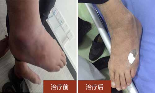 治疗前吴大爷右踝有痛风石,治疗后吴大爷右踝处痛风石已消除 郑州治痛风专家徐学成治疗二十年痛风,患者病情已好转