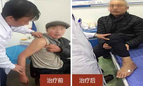 治疗前吴大爷右肩难以上举,治疗后吴大爷右肩可以正常活动 郑州治痛风专家徐学成治疗二十年痛风,患者病情已好转