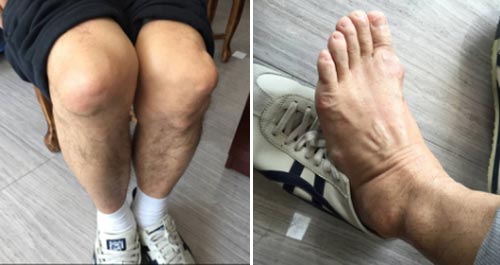 双膝、双足关节明显可见痛风石 郑州痛风风湿病医院针对痛风根源性治疗