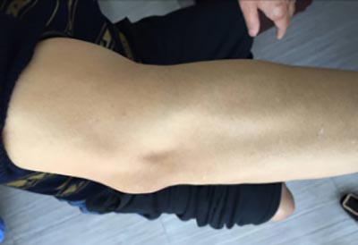 痛风多年治疗无效 郑州痛风风湿病医院医院科学治疗 郑州痛风风湿病医院针对痛风根源性治疗