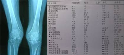 患者双膝X线检查显示关节肿大及检查化验单 风湿疼痛、肿胀经风湿病专家徐学成治疗,病情得到控制