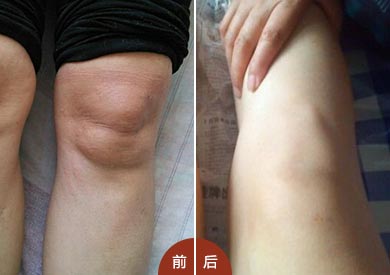 孙女士到院治疗前后对比 风湿疼痛、肿胀经风湿病专家徐学成治疗,病情得到控制