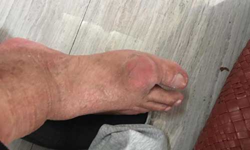 痛风石,全身多关节肿胀疼痛科学方法治疗 痛风石,全身多关节肿胀疼痛科学方法治疗