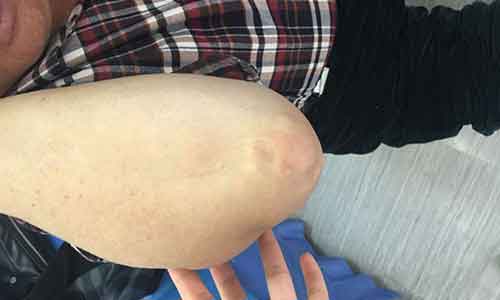 痛风石,全身多关节肿胀疼痛科学方法治疗 痛风石,全身多关节肿胀疼痛科学方法治疗